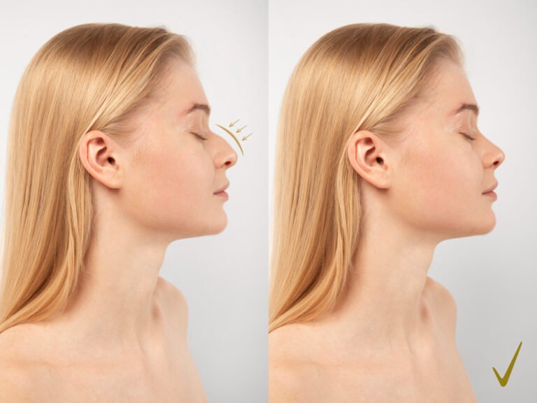 Rinoplastia: Mitos e verdades sobre o procedimento 1 rinoplastia antes depois