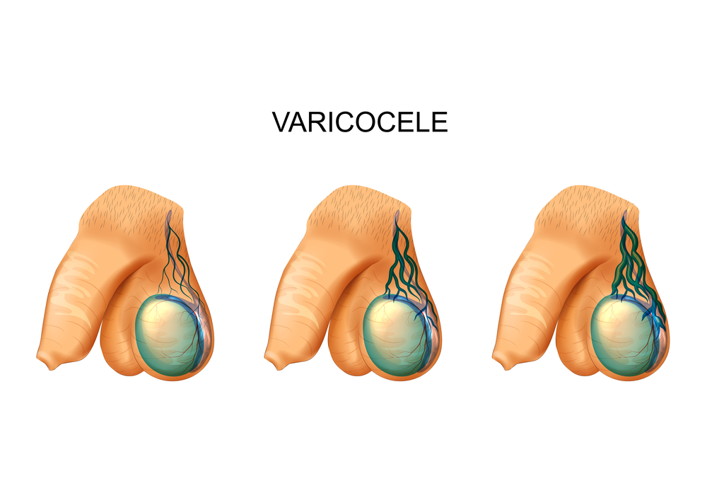 Quais são os sintomas da varicocele? 1 sintomas da varicocele